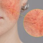 rosacea-afeccion-piel